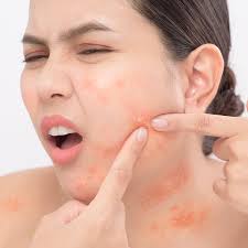Acne Causes Image 1